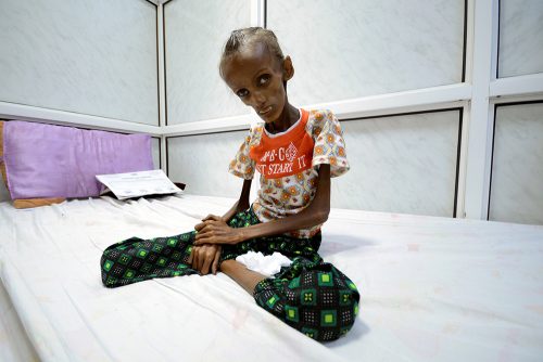 FILE PHOTO -  Saida Ahmad Baghili, 18, who is affected by severe acute malnutrition, sits on a bed at the al-Thawra hospital in the Red Sea port city of Houdieda, Yemen October 24, 2016. REUTERS/Abduljabbar Zeyad/File Photo                     REUTERS PICTURES OF THE YEAR 2016 - SEARCH 'POY 2016' TO FIND ALL IMAGES